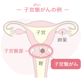 子宮頸がんの例